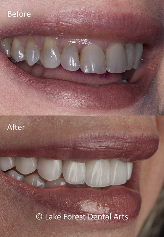 porcelain crowns were used to cover these dark teeth Dark teeth fixed before and after