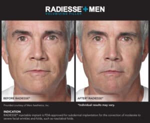 Images for Before and After Photos of Men- Radiesse Eyes- Gemini Plastic Surgery in Rancho Cucamonga, California