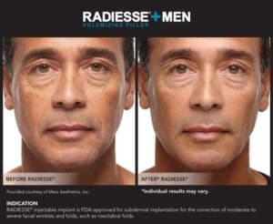 Images for Before and After Pictures of Men- Radiesse End Results- Gemini Plastic Surgery in Rancho Cucamonga, California