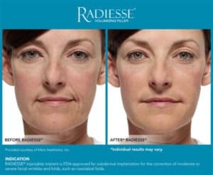 Before and After Photos- Radiesse Lips Results- Gemini Plastic Surgery in Rancho Cucamonga, California