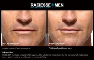 Before and After Gallery for Men- Radiesse End Results- Gemini Plastic Surgery in Rancho Cucamonga, California