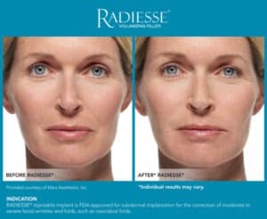 Images for Before and After Galleries- Radiesse Jawline- Gemini Plastic Surgery in Rancho Cucamonga, California