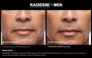 Before and After Photos for Men- Radiesse Results- Gemini Plastic Surgery in Rancho Cucamonga, California