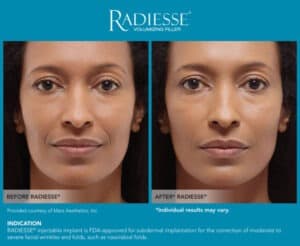 Images for Before and After Photos- Radiesse Eyes- Gemini Plastic Surgery in Rancho Cucamonga, California