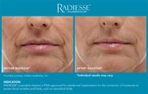 Before and After Gallery- Radiesse End Results- Gemini Plastic Surgery in Rancho Cucamonga, California