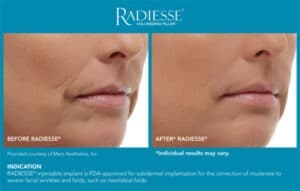 Before and After Pictures- Radiesse End Results- Gemini Plastic Surgery in Rancho Cucamonga, California