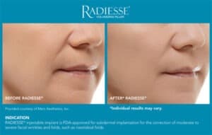 Before and After Photos- Radiesse Results- Gemini Plastic Surgery in Rancho Cucamonga, California