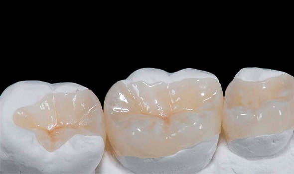 incrustaciones porcelana 590x350