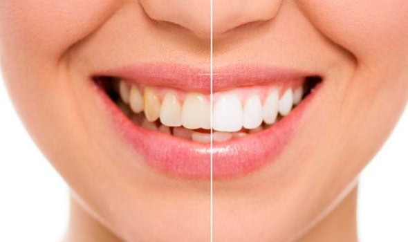 Beneficios Blanqueamiento Alfadent