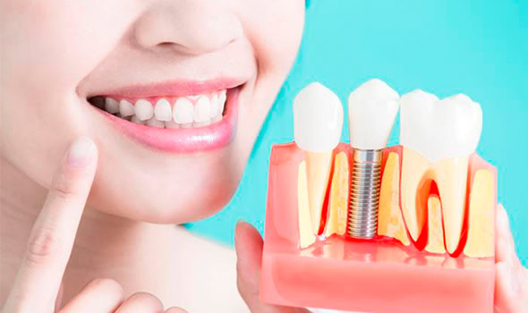 Beneficios implantes Alfadent Beneficios implantes Alfadent