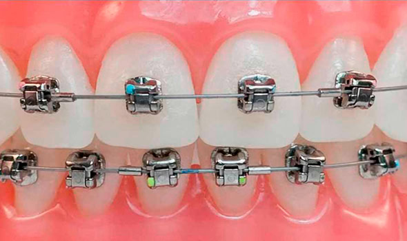 Brackets autoligables Alfadent