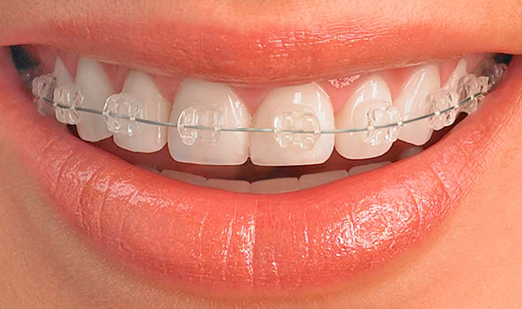 Brackets de zafiro Alfadent
