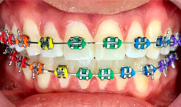 Brackets metálicos Alfadent