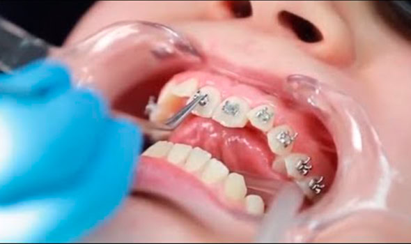 Tratamiento de ortodoncia Alfadent