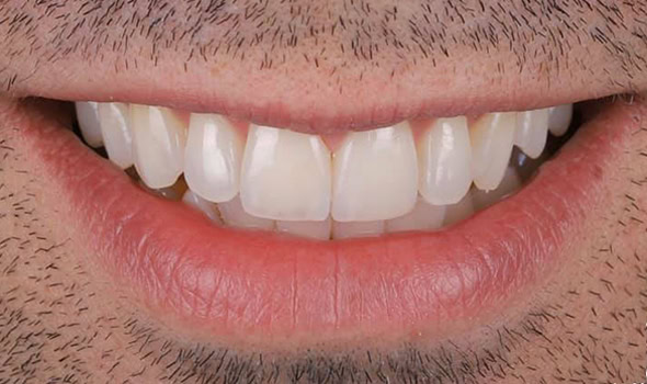 Beneficios protesis fijas 590x350 Beneficios protesis fijas 590x350