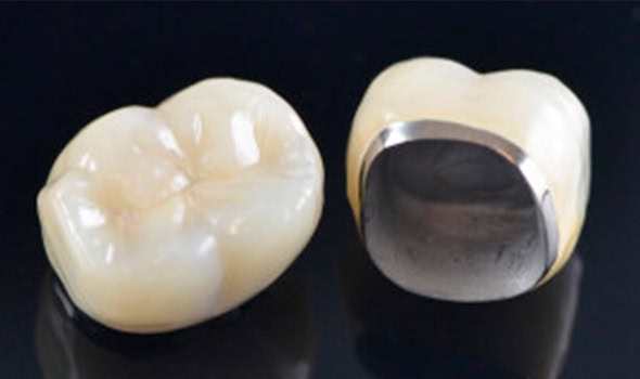 corona metal ceramica 590x350