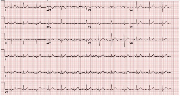 ECG of patient
