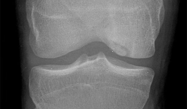 20-year-old has an incidental finding on his x-ray 20-year-old has an incidental finding on his x-ray