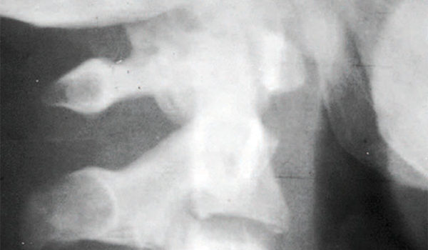 High-Risk Conditions Presenting as Back Pain (Part 2) High-Risk Conditions Presenting as Back Pain (Part 2)