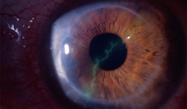 Adult with Eye Pain, Photophobia, and Decreased Vision Adult with Eye Pain, Photophobia, and Decreased Vision