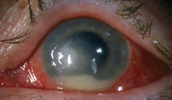 Eye Redness, Pain, and Light Sensitivity Eye Redness, Pain, and Light Sensitivity