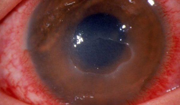 Red Painful Eye with Visual Loss Red Painful Eye with Visual Loss