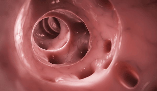 Diverticulitis in the Urgent Care Setting Diverticulitis in the Urgent Care Setting