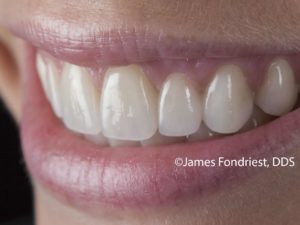 This patient chose a bridge instead of doing an implant dental bridge vs implant