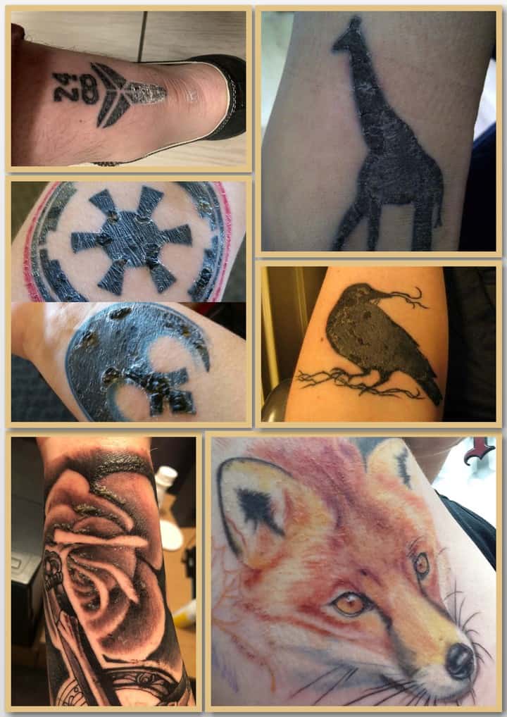 Удаление татуировок лазером - фото до и после с фото
