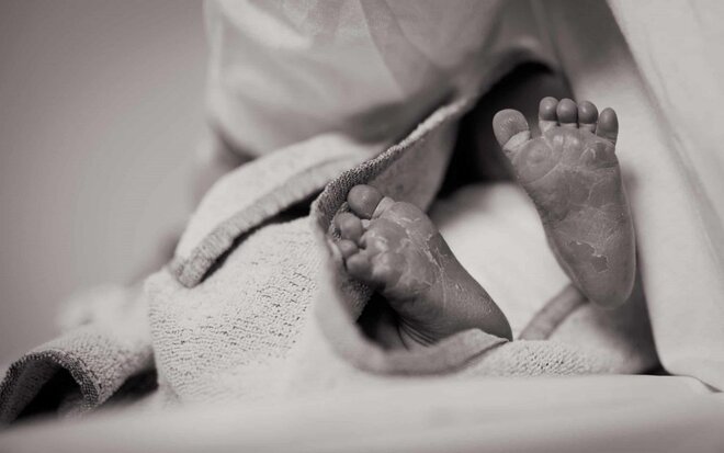 the difference between eczema and psoriasis