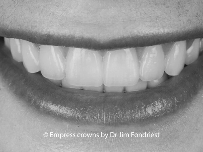 Chicago Dental Professor of Cosmetic and Restorative Dentistry Smile makeover done with Empress crowns