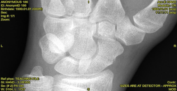 A 15-Year-Old Boy with Wrist Pain After a Fall A 15-Year-Old Boy with Wrist Pain After a Fall