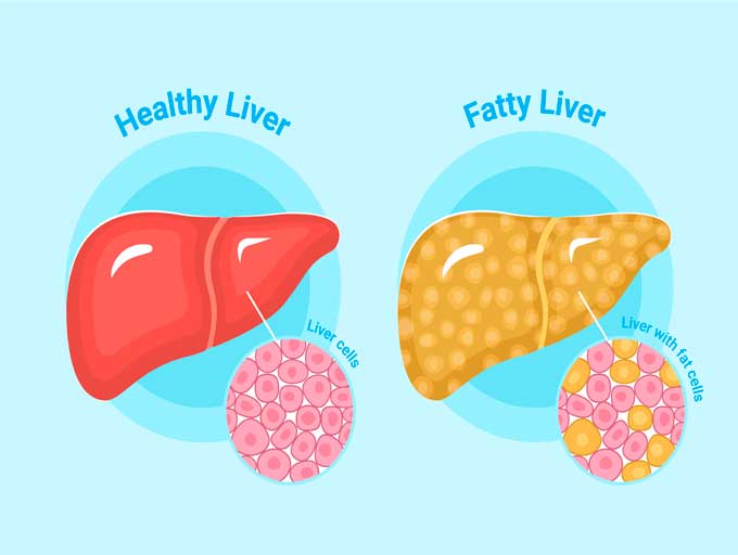 fatty-liver-disease