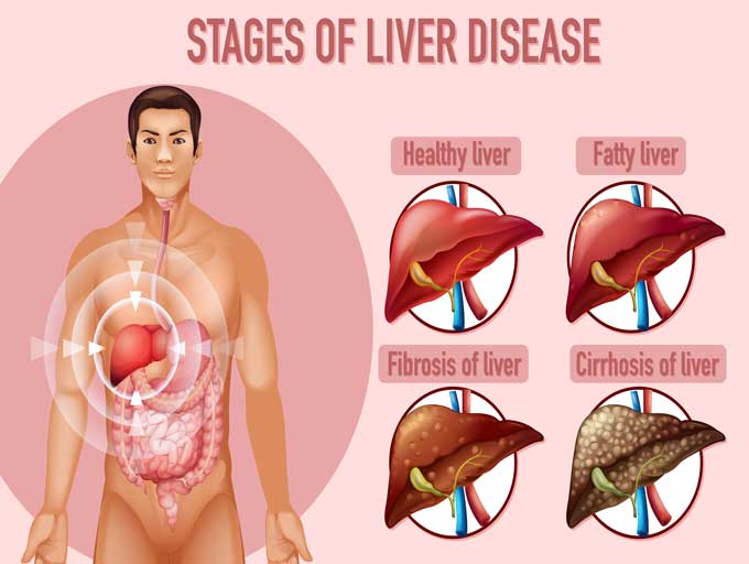 stages-of-fatty-liver