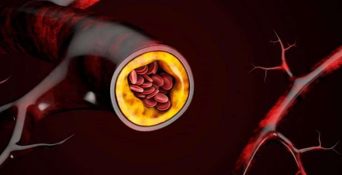 Cholesterol can clog your arteries, eventually leading to a heart attack or stroke