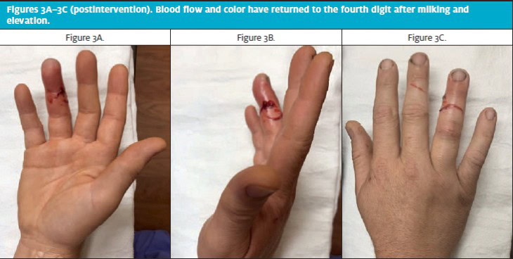 Can a Pressure Washer Cut Your Finger off 