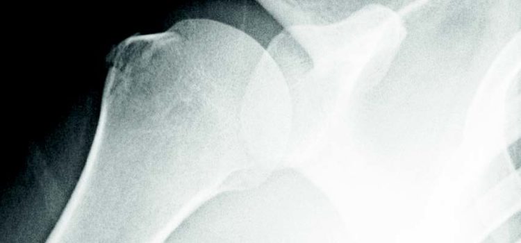 A 38-Year-Old Woman with Shoulder Pain A 38-Year-Old Woman with Shoulder Pain