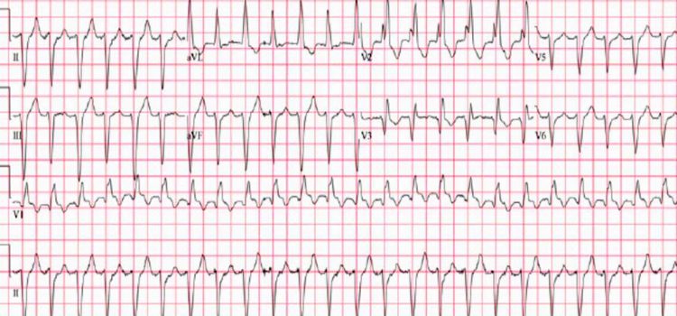 A 96-Year-Old Male with Palpitations and a History of CAD A 96-Year-Old Male with Palpitations and a History of CAD