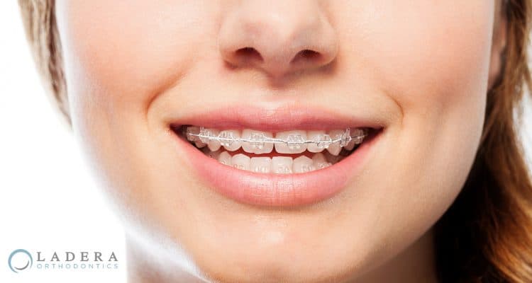 questions about braces