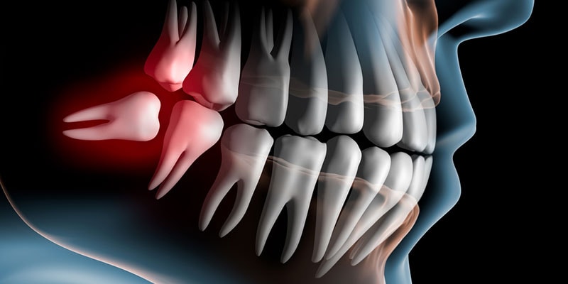5 Signs It’s Time For Wisdom Teeth Removal