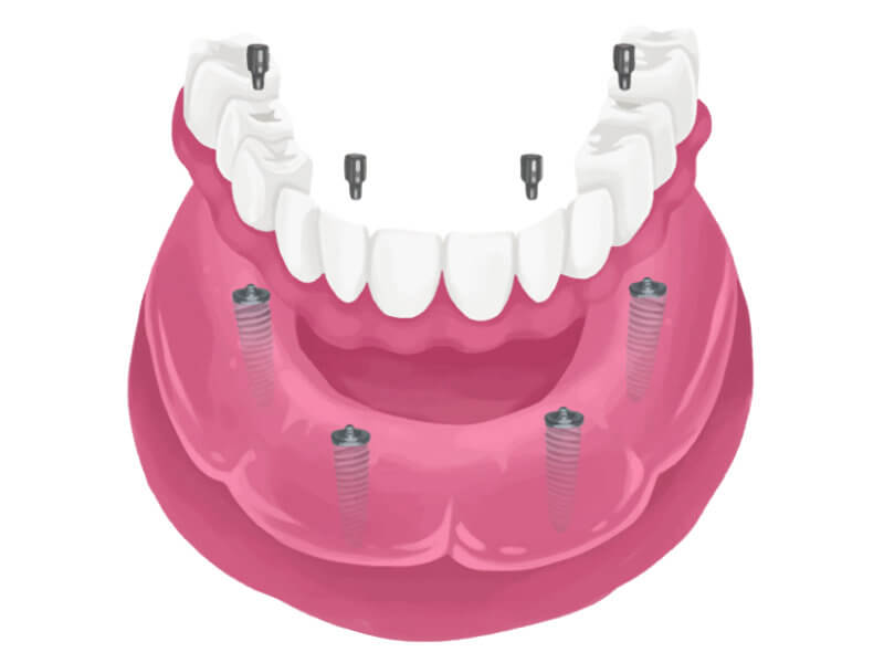 gum disease treatment affordable dentures
