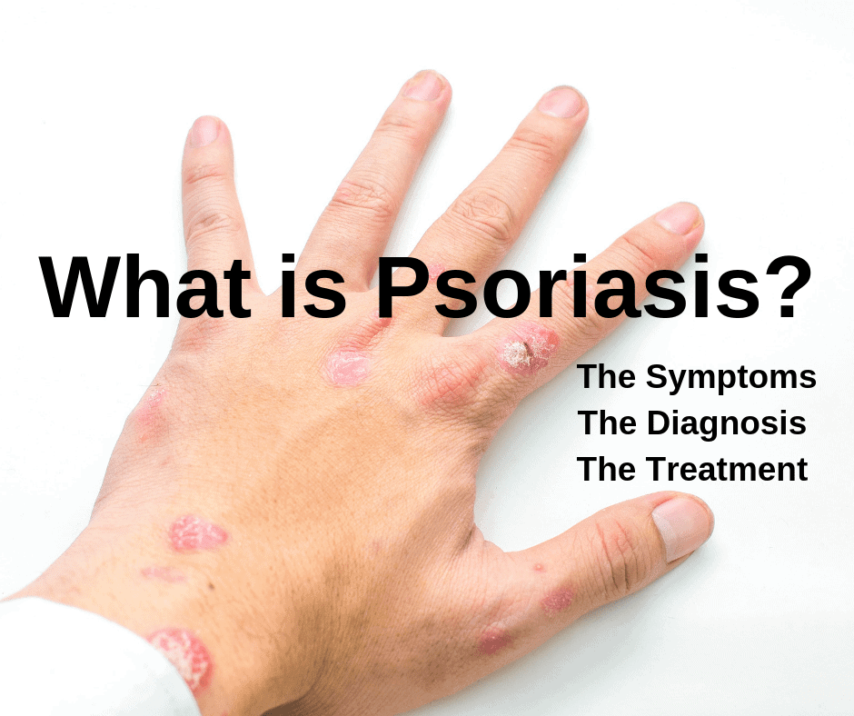 The hand with Psoriasis symptoms