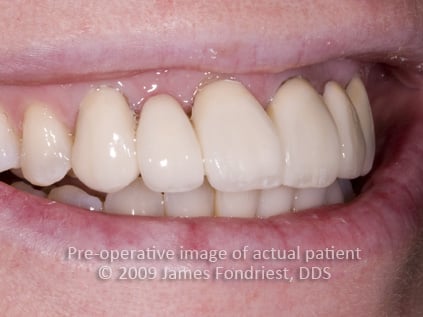 image of patient with not enough room to place an implant Minimum space for implants