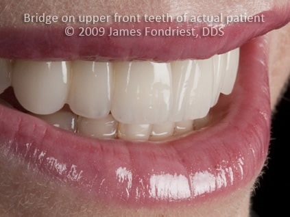 All porcelain bridge, zirconium bridge roots too close for implant