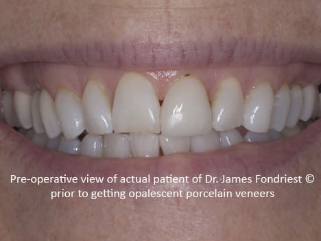 Replacing old veneers Replacing old veneers