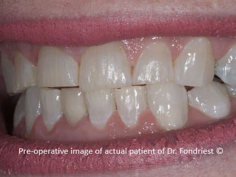 Chipped and worn teeth of a person who bruxes Chipped and worn teeth of a person who bruxes