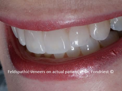 6 Feldspathic veneers on grinder 6 Feldspathic veneers on grinder