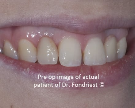 Congenitally missing lateral incisors Porcelain on gold bridgework- before