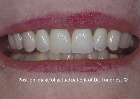 porcelain fused to gold bridges Bridge as alternative to implant
