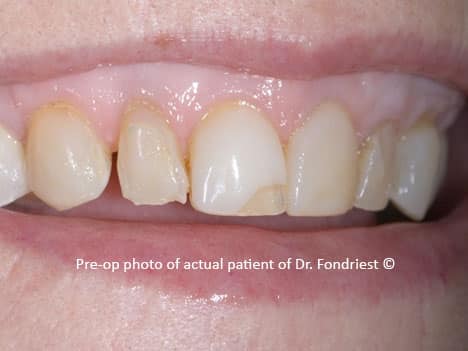 spaces or diastemas between teeth, gapped teeth spaces or diastemas between teeth, gapped teeth